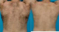 35-44 year old man treated with Laser Hair Removal