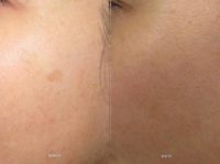 35-44 year old woman treated with Sinon Laser Treatment
