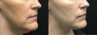35-44 year old woman treated with Ultherapy