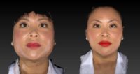 35-44 year old woman treated with Bellafill, Restylane, Botox, Ultherapy, and Photo Facial