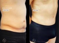 42 year old man treated with Tummy Tuck