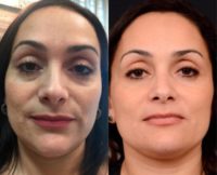 35-44 year old woman treated with Dermal Fillers for Under Eye Bags