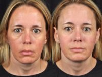 45 year old female who lost a lot of volume in her face after weight loss