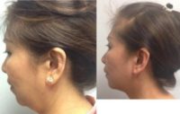 45-54 year old woman treated with Laser Surgery