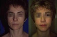 45-54 year old woman treated with Liquid Facelift