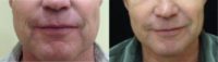 45-54 year old man treated with Microneedling