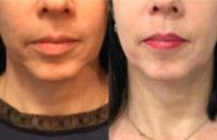 50Y.O. Female, Non Surgical Face Lift