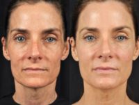 54 year old female with sun damage & loss of volume in face