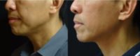 45-54 year old man treated with Ultherapy