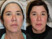 55-64 year old woman treated with Sculptra Aesthetic