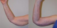 55-64 year old woman treated with Arm Lift