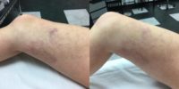 55-64 year old woman treated with Sclerotherapy