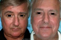 55-64 year old man treated with KTP Laser Treatment for blood vessels on the face