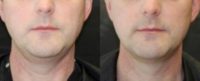 55-64 year old man treated with Ultherapy