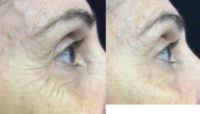 55-64 year old woman treated with Exilis