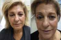 55-64 year old woman treated with ThermiSmooth Face