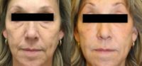 55-64 year old woman treated with Restylane Defyne