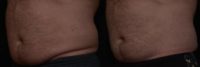 55-64 year old man treated with CoolSculpting for his lower abdomen
