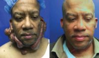 55-64 year old man treated with Scar Removal
