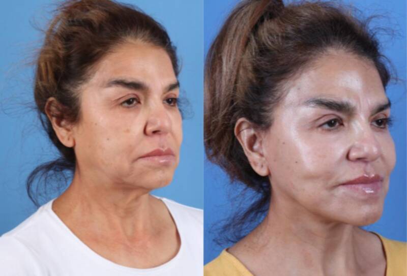 61 year old woman treated with Facelift, Platysmaplasty, Fat grafting to temples, and Laser Resurfacing to upper and lower eyeli