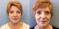 55-64 year old woman treated with SMAS facelift, bilateral lower blephroplasty & full face TCA Peel