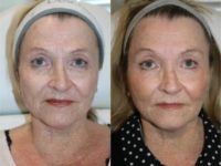 65-74 year old woman treated with Sculptra Aesthetic