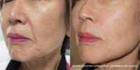65-74 year old woman treated with Injectable Fillers