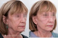 68 Year Old Woman Facelift