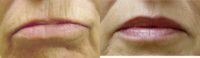 68 Year Old Woman Treated with Restylane