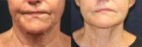 65-74 year old woman treated with Laser Surgery