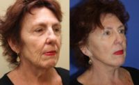 65-74 year old woman treated with Modified Facelift