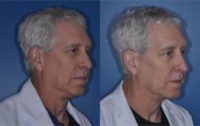 65-74 year old man treated with Ultherapy