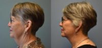 65-74 year old woman treated with Facelift, Neck Lift, Facial Fat Transfer, Chin Liposuction