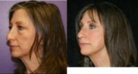 Cheek lift with eyelids and laser