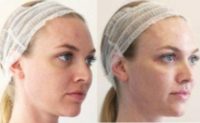 35-44 year old woman treated with Dermal Fillers