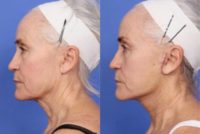 73 year old woman treated with Neck Lift