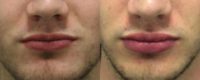 18-24 year old man treated with Juvederm