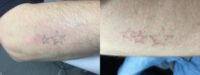 18-24 year old man treated with Tattoo Removal