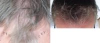 45-54 year old man treated with NeoGraft