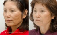 65 Year Old Woman Facelift