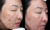35-44 year old woman treated Without Microdermabrasion