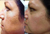 45-54 year old woman treated with eMatrix