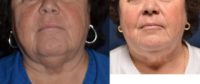 57 year old female for chin coolsculpting