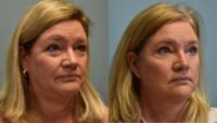 55-64 year old woman treated with Facelift, Eyelid Surgery, Facial Fat Transfer