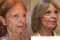 55-64 year old woman treated with Modified Facelift