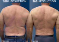 49 year old man treated with Liposuction