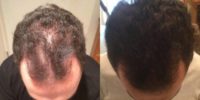 25-34 year old man treated with PRP for Hair Loss Low Laser Light Therapy