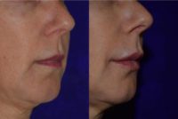 50 year old woman treated with Juvederm VOLBELLA