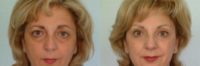 53 year old upper and lower eyelid surgery