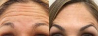 36 Year Old Female Treated For Forehead Wrinkles